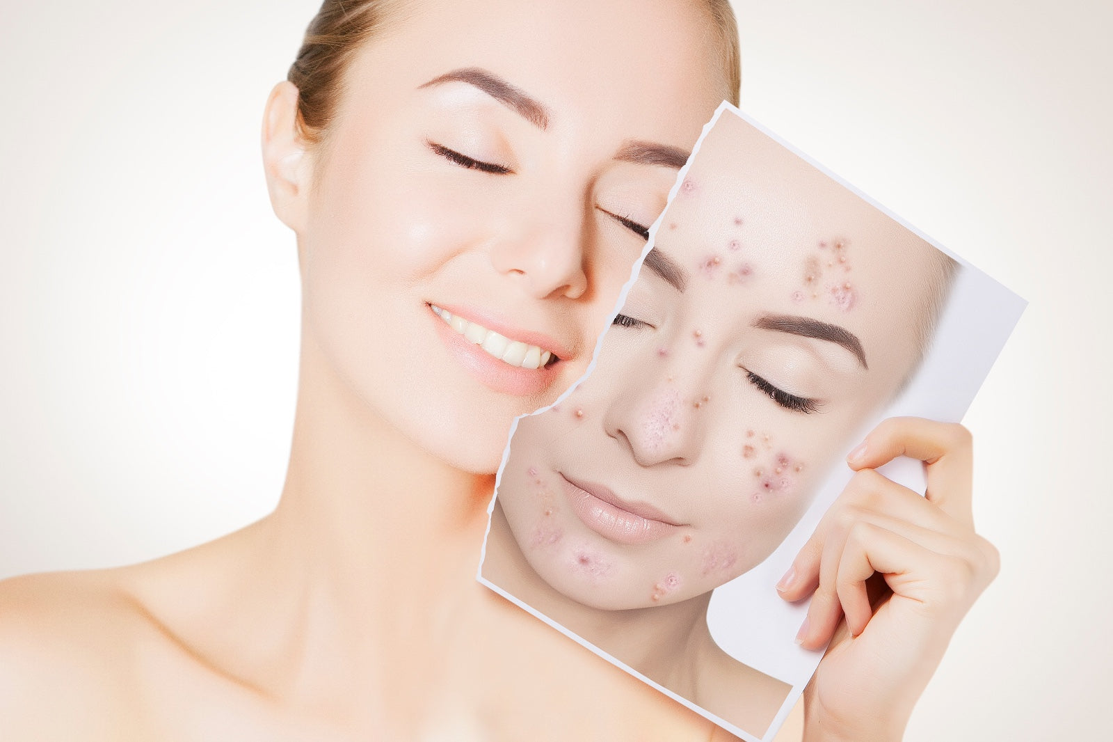 Combatting Acne: Your Guide to Clear Skin with EUROSOFT