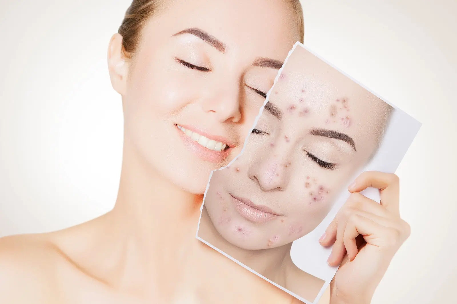 Combatting Acne: Your Guide to Clear Skin with EUROSOFT