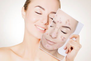 Combatting Acne: Your Guide to Clear Skin with EUROSOFT